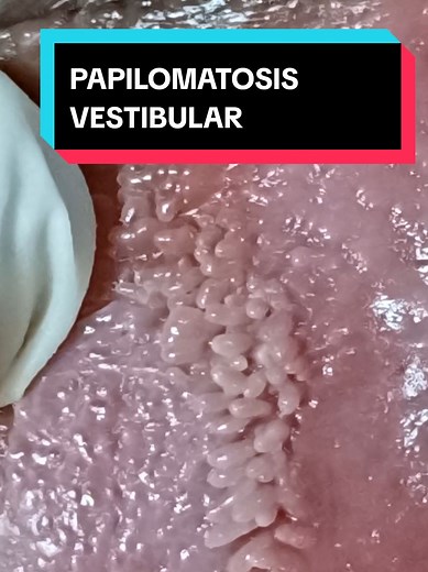 Papilomatosis Vestibular: ¿Qué Es y Cómo Reconocerla?