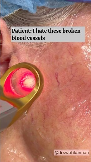 Get Rid of Broken Blood Vessels 👩🏽‍⚕️