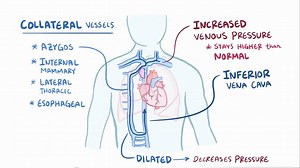 Superior vena cava syndrome | Cardiology and CCU