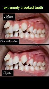 12K views · 59 reactions | The first time you get braces put on, you can expect sore teeth to last for about a week. You will never experience major pain. Rather, it will feel like a slight tenderness when you do things with your mouth like chewing. During this first week, you'll want to avoid chewing anything too hard. #bracestrendingcolor #bracestipsandadvice #dentalideas #braceslife #BracesCare #bracestips #everyone #followers #highlights #braces | Braces Shop Online | Facebook