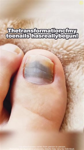 Effective Nail Fungus Treatment You Can Trust