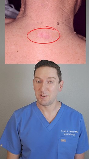 846K views · 14K reactions | Did you recognize these as skin cancers? These are three common types of skin cancer I find on a daily basis. #typesofskincancer #skincancerawareness #basalcellcarcinoma #squamouscellcarcinoma #melanoma #eczema #dermatologist #skincancer #creatorsearchinsights | Scott Walter MD, FAAD | Facebook