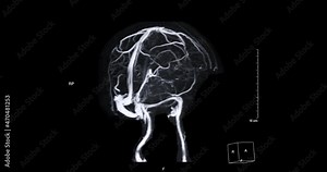 MRV Brain or magnetic resonance venography of The Brain turn around on the screen for abnormalities in venous drainage of the brain.