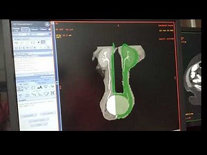 Post processing on ge ADW CT UROGRAPHY # @MRICTScanTech @3DParamedical