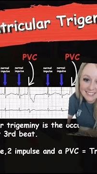 Ventricular Trigeminy || EMS Cardiology