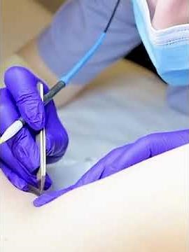 "Electrolysis vs. Laser Hair Removal: Key Differences and How They Work"