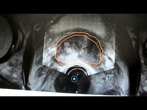 MRI Fusion Targetted Prostate Biopsies