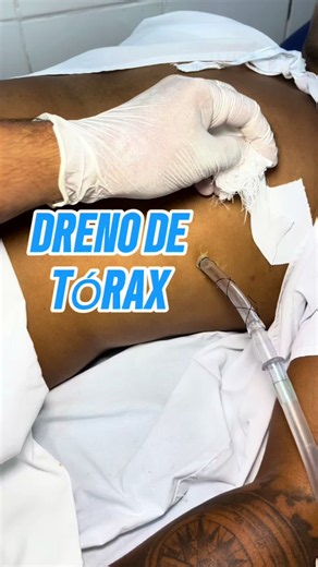 📌 Cuidados essenciais com o dreno de tórax: o que a enfermagem precisa observar? . . . . . . . #enfermagem #nurse #saude #drenodetorax