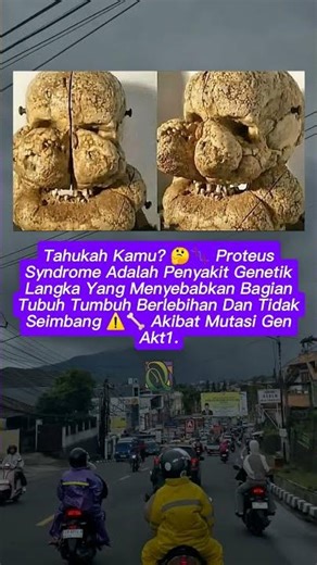 Proteus Syndrome: Penyakit Langka yang Menyebabkan Pertumbuhan Tubuh Tidak Simetris