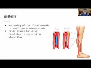 Peripheral Vascular Disease - NPTE-PTA Board Prep