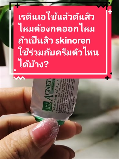 การใช้เรตินเอและสกินอเรนสำหรับการรักษาสิว