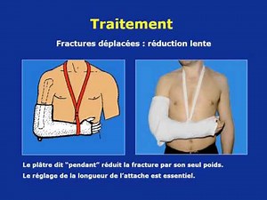 traumatologie Fractures de l’extrémité supérieure de l’humérus 2