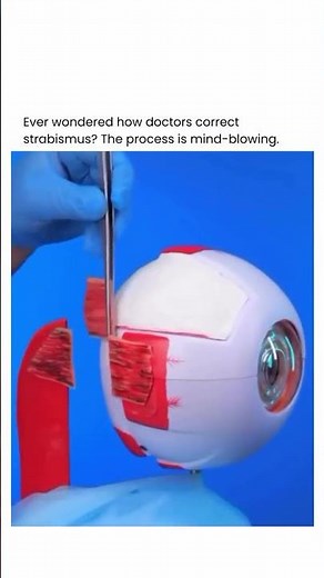 How surgeons fix a lazy eye #crazy #strabismus