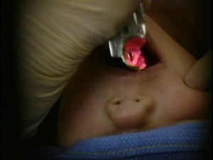 Child Miller large tonsils