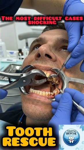 This Rusty Nail Was Stuck Inside a Dentist's Mouth!🛠️🚑