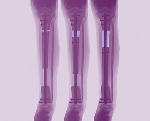 Precice Bone Transport - Exclusive virtual event - NuVasive