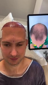 Confidence Restored: Hair Transplant Success Stories at Tas Hair Clinic