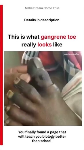 🦶This is what gangrene toe ⚠️ really looks like | MDCT
