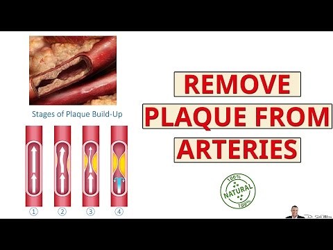 How To Remove Calcium Deposits From Your Arteries - by Dr Sam Robbins