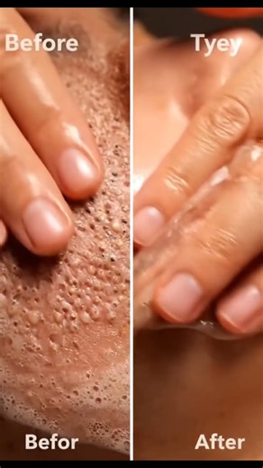 Ultra-Realistic ASMR Facial Extraction | Deep Pore Suction, Close-Up Skin Texture