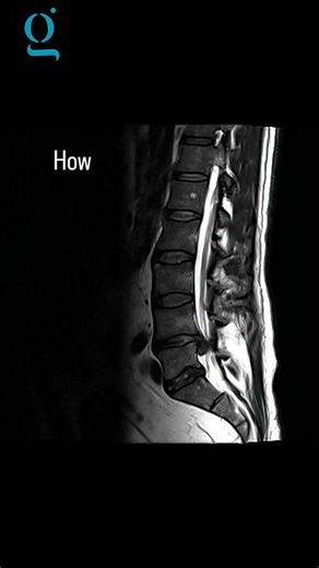 Dr Piyush Jain PT on Instagram: "Just basic movement to check motor involvement in disc compression without an MRI #pivd #sciatica #drpiyushjain #physiotherapy"