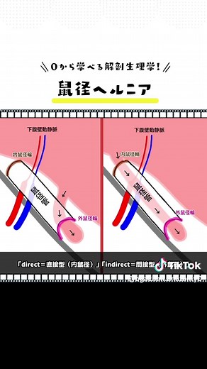 鼠径ヘルニアの仕組みと治療法