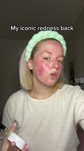 Makeup Hacks for Redness: Covering Red Spots with Ease