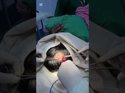 Excision of Pyogenic granuloma on scalp under local anaesthesia