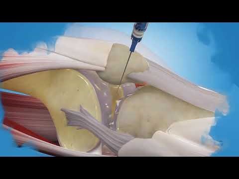 SYNVISC tecnica aplicacion 2020 1