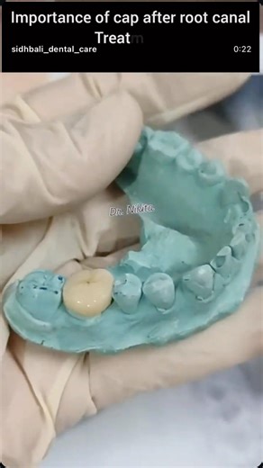 Wondering why you need a cap after getting a root canal treatment done?? #smiledesigndental