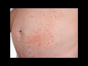 EXFOLIATIVE DERMATITIS EXFOLIATIVE ERYTHRODERMA CAUSES SYMPTOMS TREATMENT CLINICAL DATA