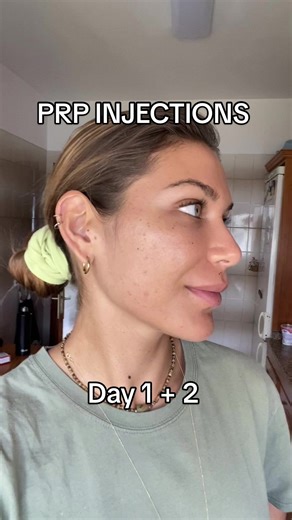 PRP Injections Review: Glow and Swelling Explained