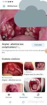 Angine Blanche, Causes Symptômes et Traitements