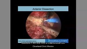 Translanal Total Mesorectal Excicion (taTME)