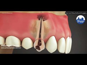 Extraction for Unchecked Decay - Philadelphia dental