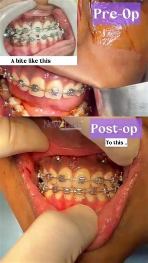 Dr Mathew PC | Bite Alignment Change | Jaw Surgery Case Visual
