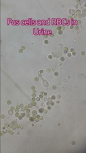 Pus cells and RBCs in Urine Microscopy