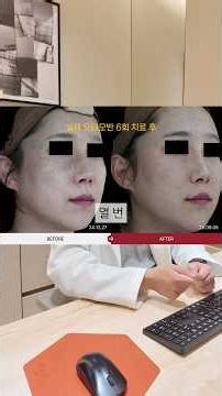 오타모반, 밀크커피반점, 흑자 등 난치성 색소는 어떻게 치료할까요?