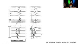 Mapping to Characterize Conduction System Blocks and Capture