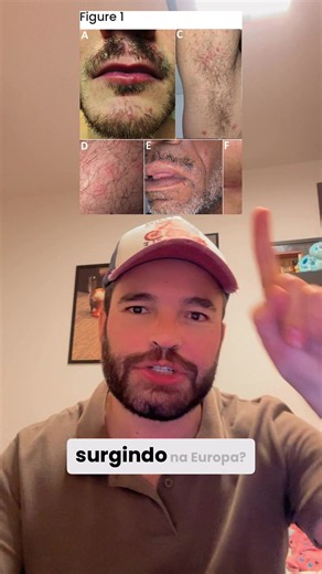 Uma nova IST está surgindo? Calma. 🚨 Um estudo publicado pelo CDC descreveu 9 casos de dermatofilose em homens na Europa. A doença é causada pela bactéria Dermatophilus congolensis, tradicionalmente associada a animais como bovinos, ovinos e cavalos. Os pacientes apresentaram lesões na pele após contato sexual, levantando a hipótese de transmissão entre humanos durante relações íntimas. Ainda não está claro se estamos diante de uma nova IST ou de uma infecção oportunista transmitida em contexto