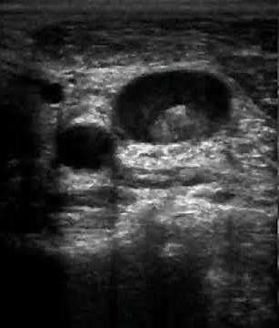 VIDEO 5: Left Internal Jugular Vein Thrombosis