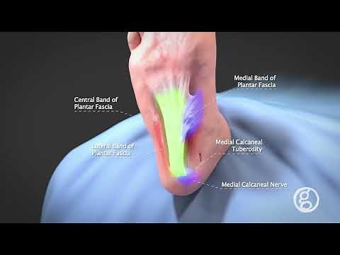 Plantar Fascia Release with MicroAire SmartRelease - Ghost Productions Medical Animation