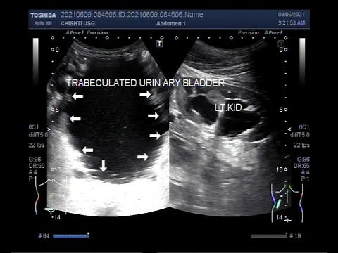 A trabeculated urinary bladder with bilateral renal dilated pelvicalyceal System.