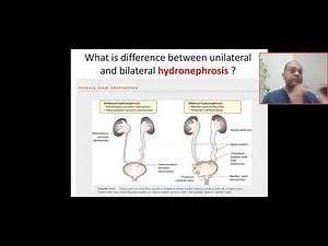 What is the difference between unilateral and bilateral hydronephrosis? PUV, bladder neck obstructio