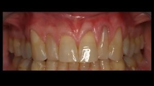Receding Gums - Periodontist Wilmington