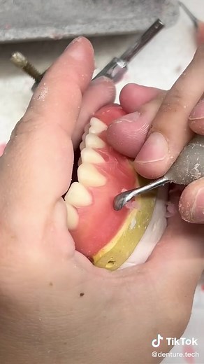 Crafting Immediate Upper Dentures at Demartin Dental