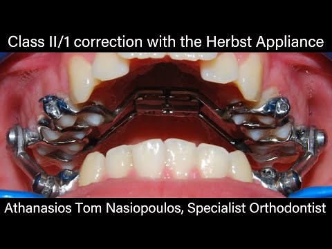 Class II correction with Herbst Appliance | Tom Nasiopoulos