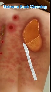 Extreme Back Cleaning ASMR Animation | Pimples Popping Scar Removal & Oddly Satisfying || #animation #treatment #satisfying #reels #trending #cleaning #shorts #reel | Akhilesh Yadav