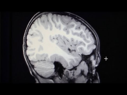 Big brains and white matter: Two studies reveal clues about autism subtypes
