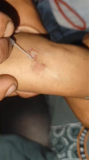 IV Cannulation Technique Procedure #mbbs #shortvideo